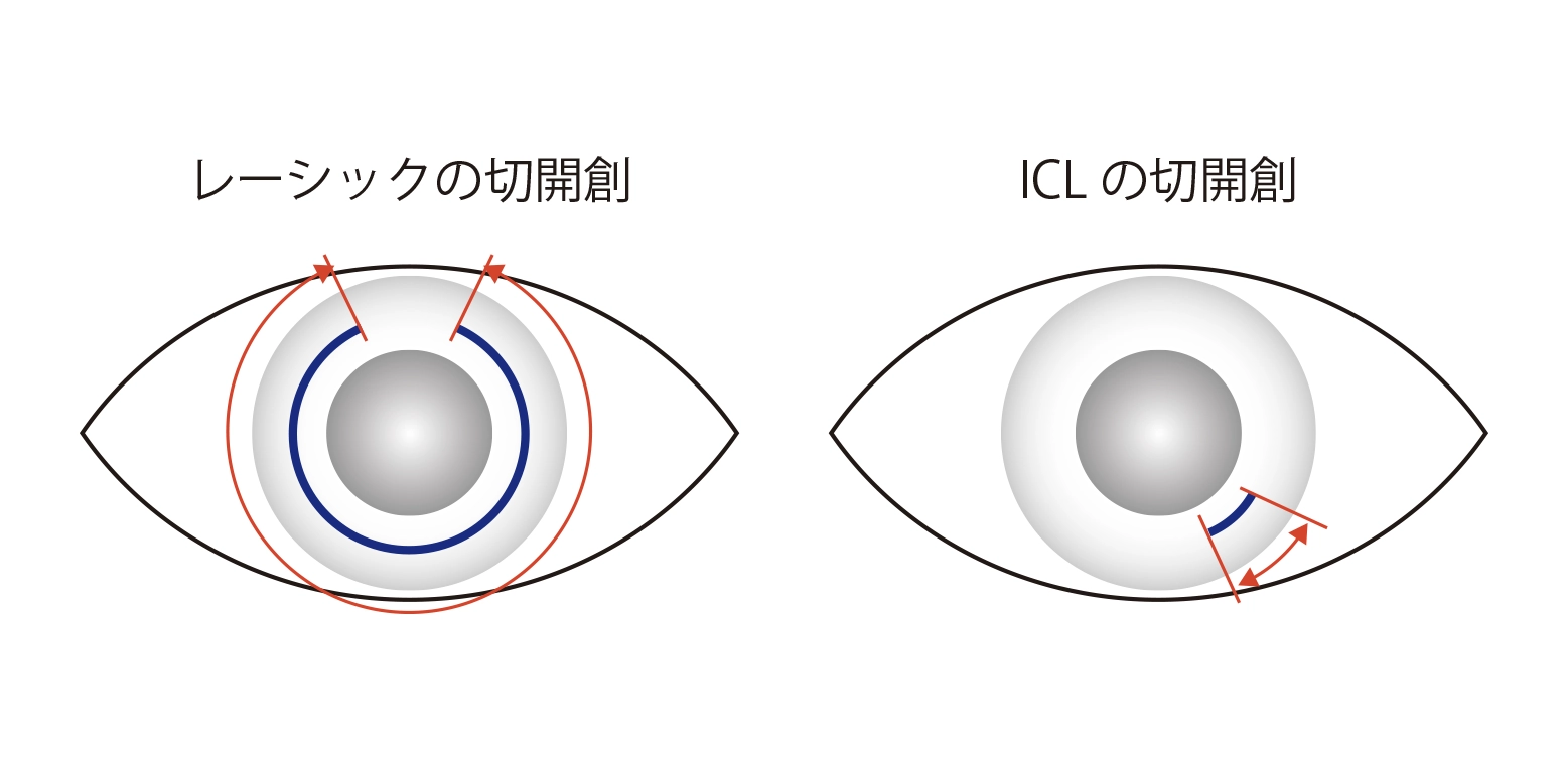 正しいICL手術とレーザーICL手術の切開創の位置比較