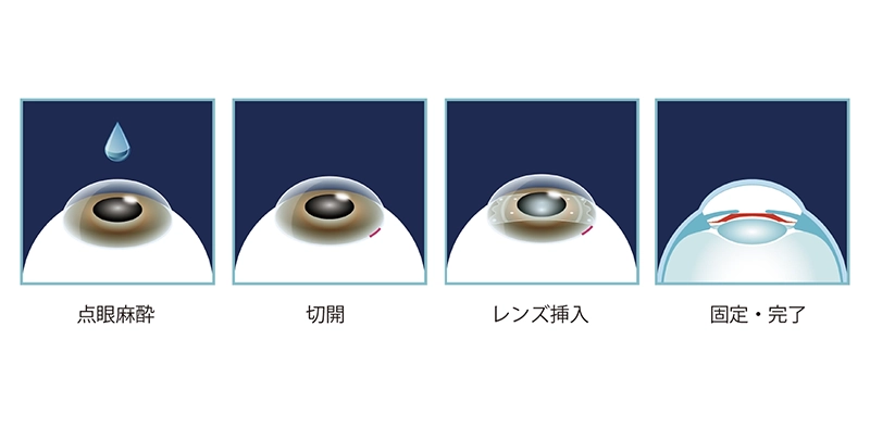 ICL手術の流れ