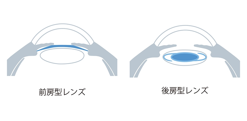 前房型レンズと後房型レンズ